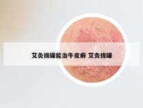 艾灸拔罐能治牛皮癣 艾灸拔罐