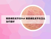 银屑病性关节炎PsA 银屑病性关节炎怎么治疗最好