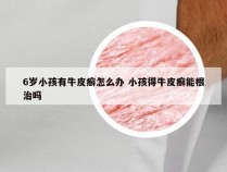 6岁小孩有牛皮癣怎么办 小孩得牛皮癣能根治吗