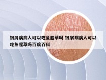 银屑病病人可以吃鱼腥草吗 银屑病病人可以吃鱼腥草吗百度百科