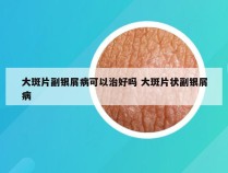 大斑片副银屑病可以治好吗 大斑片状副银屑病