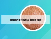 银屑病的要预防什么 银屑病 预防