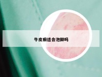 牛皮癣适合泡脚吗