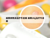 麻黄四物汤治疗牛皮癣 麻黄20g治疗牛皮癣
