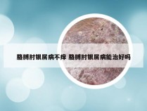 胳膊肘银屑病不痒 胳膊肘银屑病能治好吗