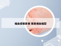 燥血症银屑病 银屑病血燥型