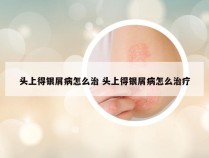 头上得银屑病怎么治 头上得银屑病怎么治疗