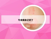 牛皮癣自己好了