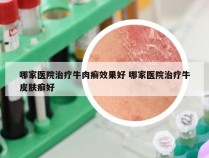 哪家医院治疗牛肉癣效果好 哪家医院治疗牛皮肤癣好