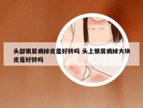 头部银屑病掉皮是好转吗 头上银屑病掉大块皮是好转吗