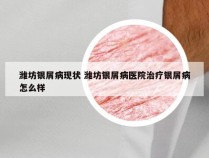 潍坊银屑病现状 潍坊银屑病医院治疗银屑病怎么样