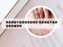 银屑病是不是很容易想睡觉 银屑病是不是很容易想睡觉呢