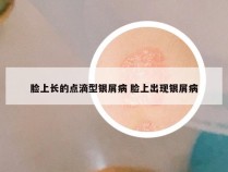 脸上长的点滴型银屑病 脸上出现银屑病