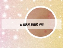 白癜风早期图片手臂