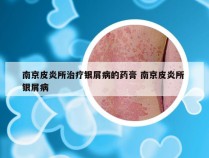 南京皮炎所治疗银屑病的药膏 南京皮炎所 银屑病