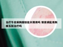 治疗牛皮癣胸腺肽能长期用吗 银屑病能用胸腺五肽治疗吗