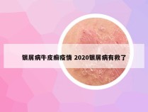银屑病牛皮癣疫情 2020银屑病有救了