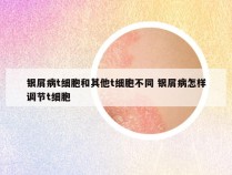 银屑病t细胞和其他t细胞不同 银屑病怎样调节t细胞