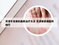 天津牛皮癣的最新治疗方法 天津银屑病医院排行