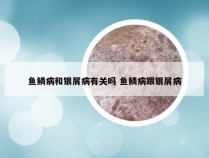 鱼鳞病和银屑病有关吗 鱼鳞病跟银屑病