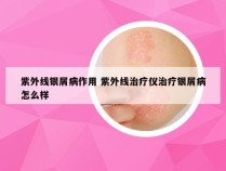 紫外线银屑病作用 紫外线治疗仪治疗银屑病怎么样