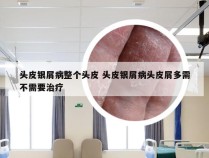 头皮银屑病整个头皮 头皮银屑病头皮屑多需不需要治疗