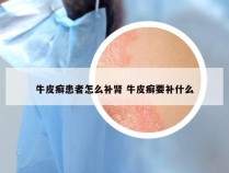牛皮癣患者怎么补肾 牛皮癣要补什么