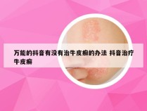 万能的抖音有没有治牛皮癣的办法 抖音治疗牛皮癣