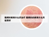 胳膊肘癣用什么药治疗 胳膊肘的癣用什么药能擦好