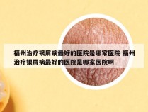 福州治疗银屑病最好的医院是哪家医院 福州治疗银屑病最好的医院是哪家医院啊