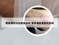 银屑病可以吃鱿鱼丝吗 银屑病患者能吃鱼吗