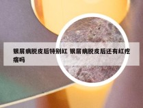 银屑病脱皮后特别红 银屑病脱皮后还有红疙瘩吗