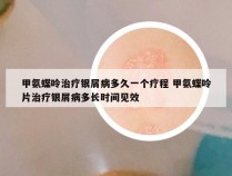 甲氨蝶呤治疗银屑病多久一个疗程 甲氨蝶呤片治疗银屑病多长时间见效