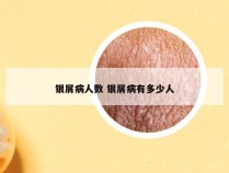 银屑病人数 银屑病有多少人
