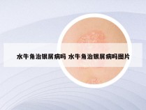 水牛角治银屑病吗 水牛角治银屑病吗图片