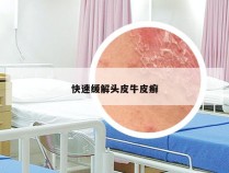 快速缓解头皮牛皮癣