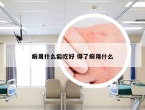 癣用什么能吃好 得了癣用什么
