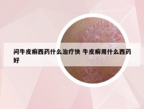 问牛皮癣西药什么治疗快 牛皮癣用什么西药好