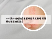 uvb紫外线光治疗银屑病容易复发吗 紫外线对银屑病的治疗