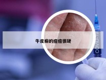 牛皮癣的痘痘很硬