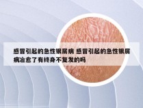 感冒引起的急性银屑病 感冒引起的急性银屑病冶愈了有终身不复发的吗
