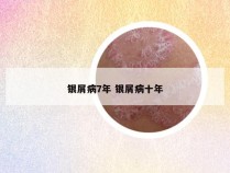 银屑病7年 银屑病十年
