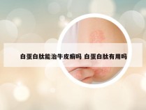 白蛋白肽能治牛皮癣吗 白蛋白肽有用吗