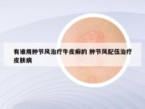 有谁用肿节风治疗牛皮癣的 肿节风配伍治疗皮肤病