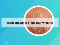 银屑病周围起红疹子 银屑病起了好多红点