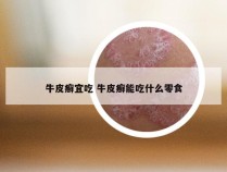 牛皮癣宜吃 牛皮癣能吃什么零食