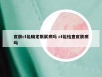 皮肤ct能确定银屑病吗 ct能检查皮肤病吗