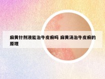 麻黄针剂液能治牛皮癣吗 麻黄汤治牛皮癣的原理