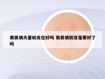 银屑病大量蜕皮在好吗 银屑病脱皮是要好了吗