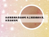 头皮银屑病头发会掉吗 头上银屑病掉头发,头发会掉光吗